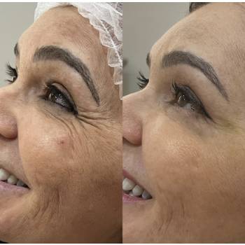 Botox Na Testa em Água Funda