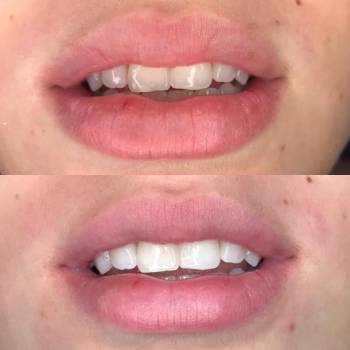 Clareamento Dental a Laser na Luz