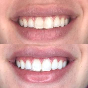 Clareamento Dental Preço em Guarulhos