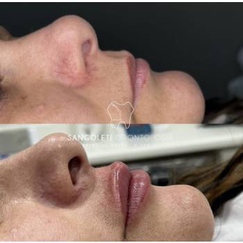 Harmonização Orofacial em Guarulhos