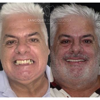 Protese Dentaria Parafusada em CECAP - Guarulhos