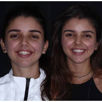 Valor Lente De Contato Dental em CECAP - Guarulhos